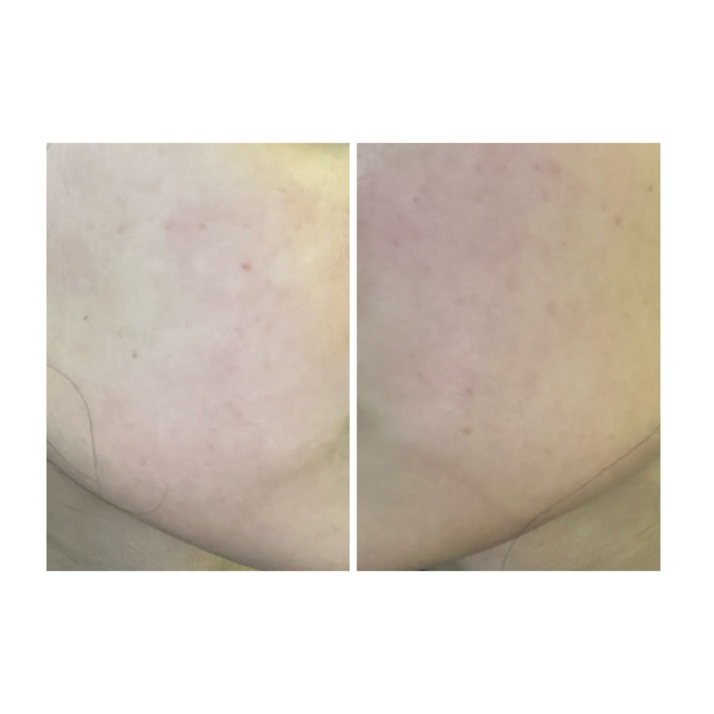 ぽむ on LIPS 「2023.9.13皮膚科に受診 エピデュオとヘパリン処方1枚目..」(4枚目)