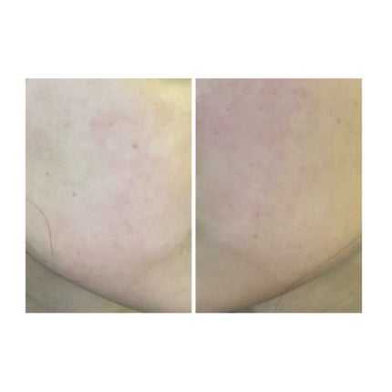 ぽむ on LIPS 「2023.9.13皮膚科に受診 エピデュオとヘパリン処方1枚目..」(4枚目)