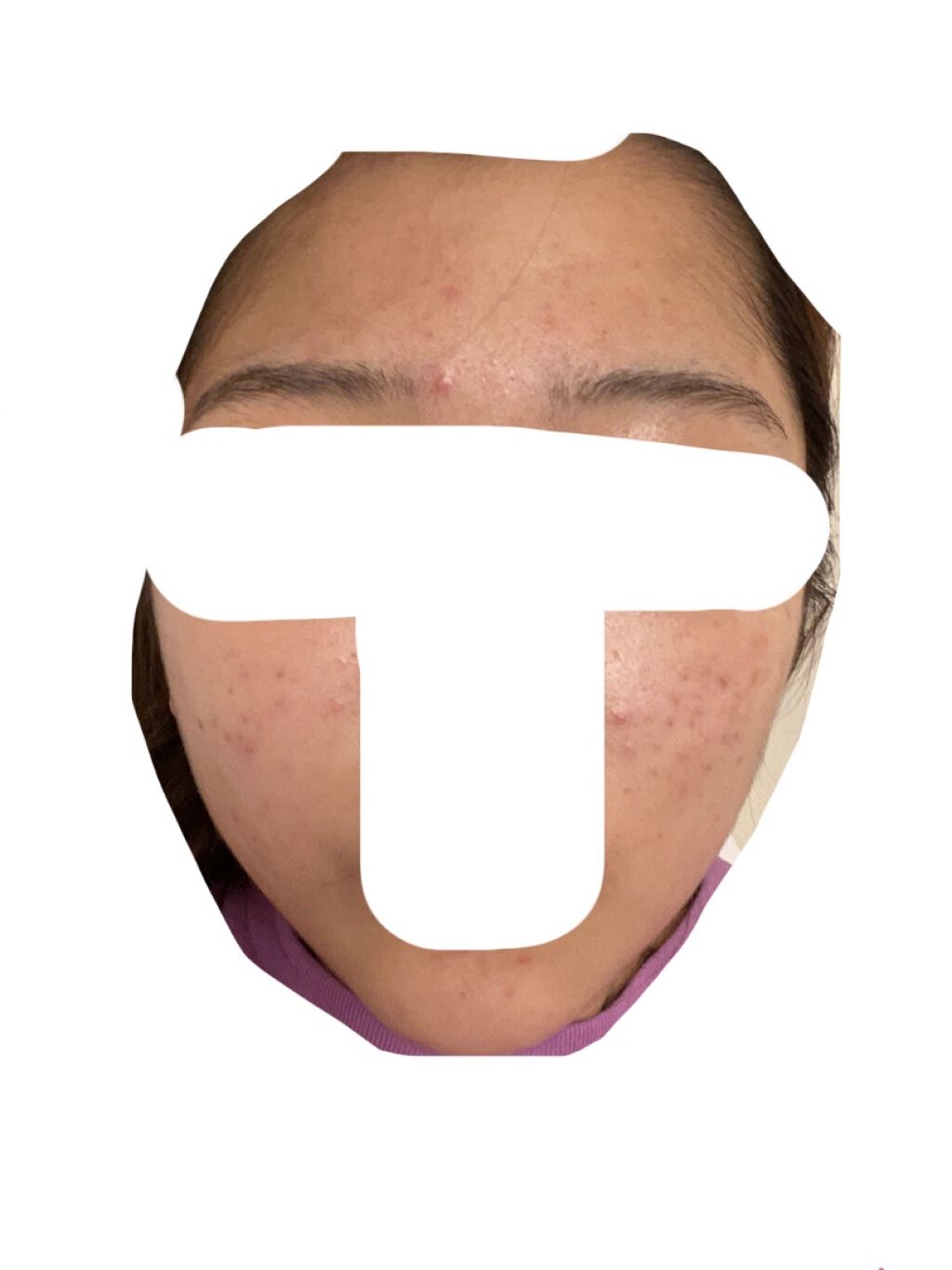 ヒルマイルドクリーム(医薬品)/健栄製薬/その他を使ったクチコミ（1枚目）