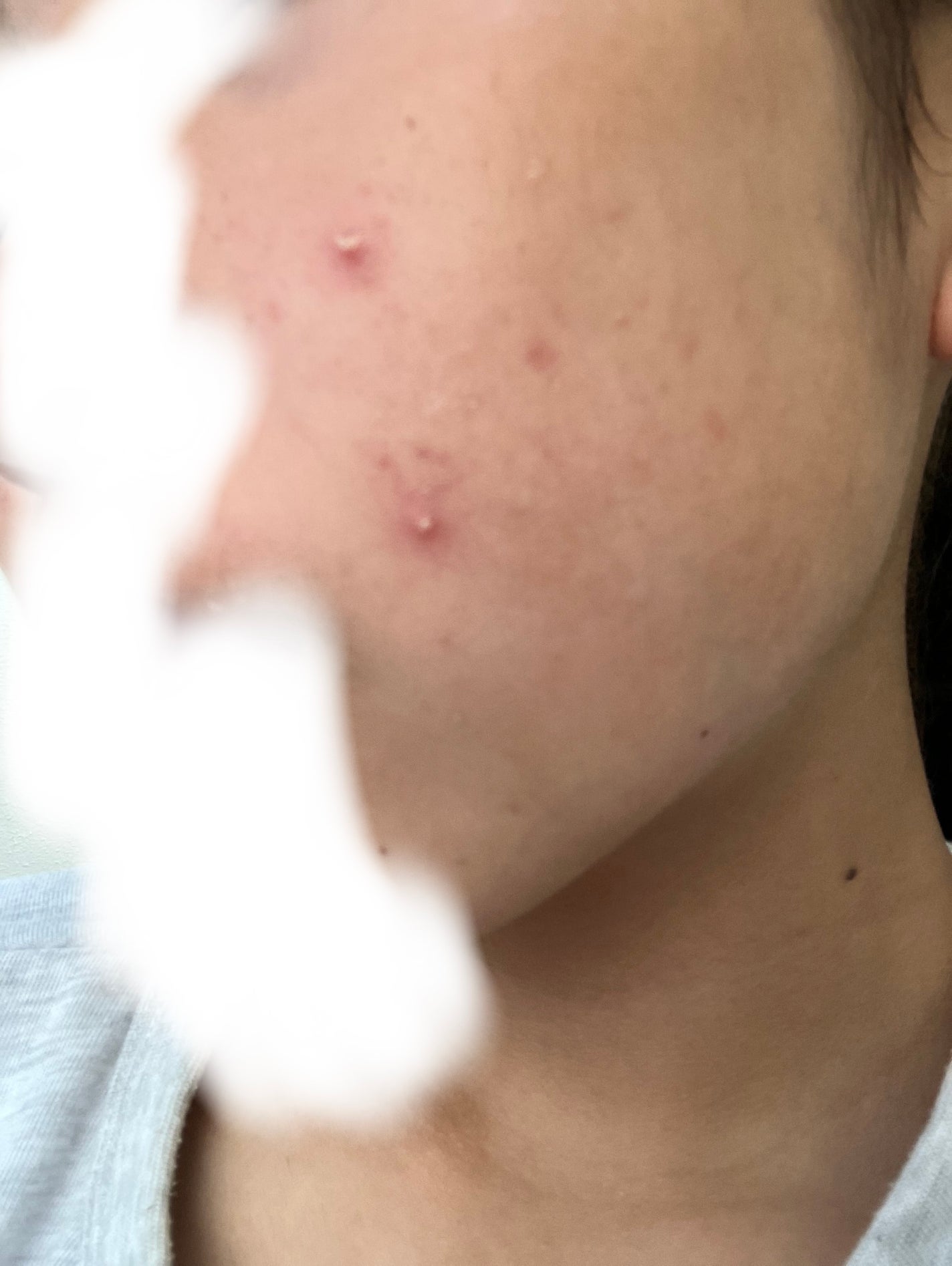 ダーマレーザー スーパーTEATREE100マスク/クオリティファースト/シートマスク・パックを使ったクチコミ(1枚目)