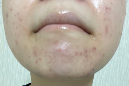 まままこ on LIPS 「ニキビゼロ肌を目指して〜8/17〜⚠️2枚目から肌画像ありスキ..」(4枚目)