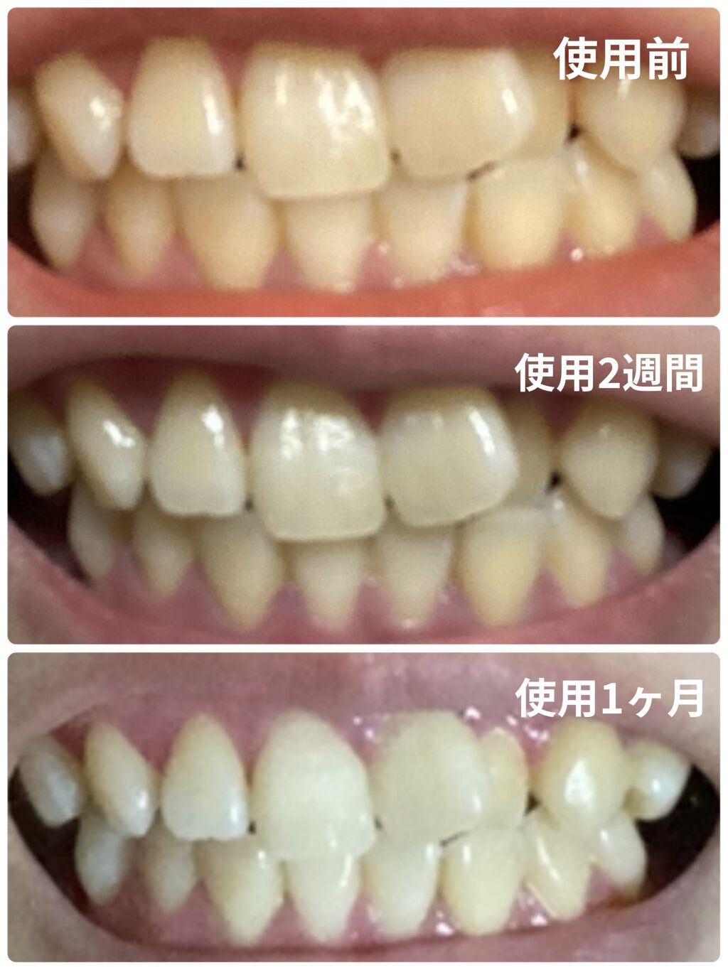 アパガードプレミオ/アパガード/歯磨き粉を使ったクチコミ（2枚目）