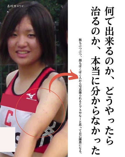 おゆみ|ニキビ・ニキビ跡ケア on LIPS 「【しくじり先生、おゆみニキビでこぼこ全史①】こんばんは。自己紹..」(7枚目)