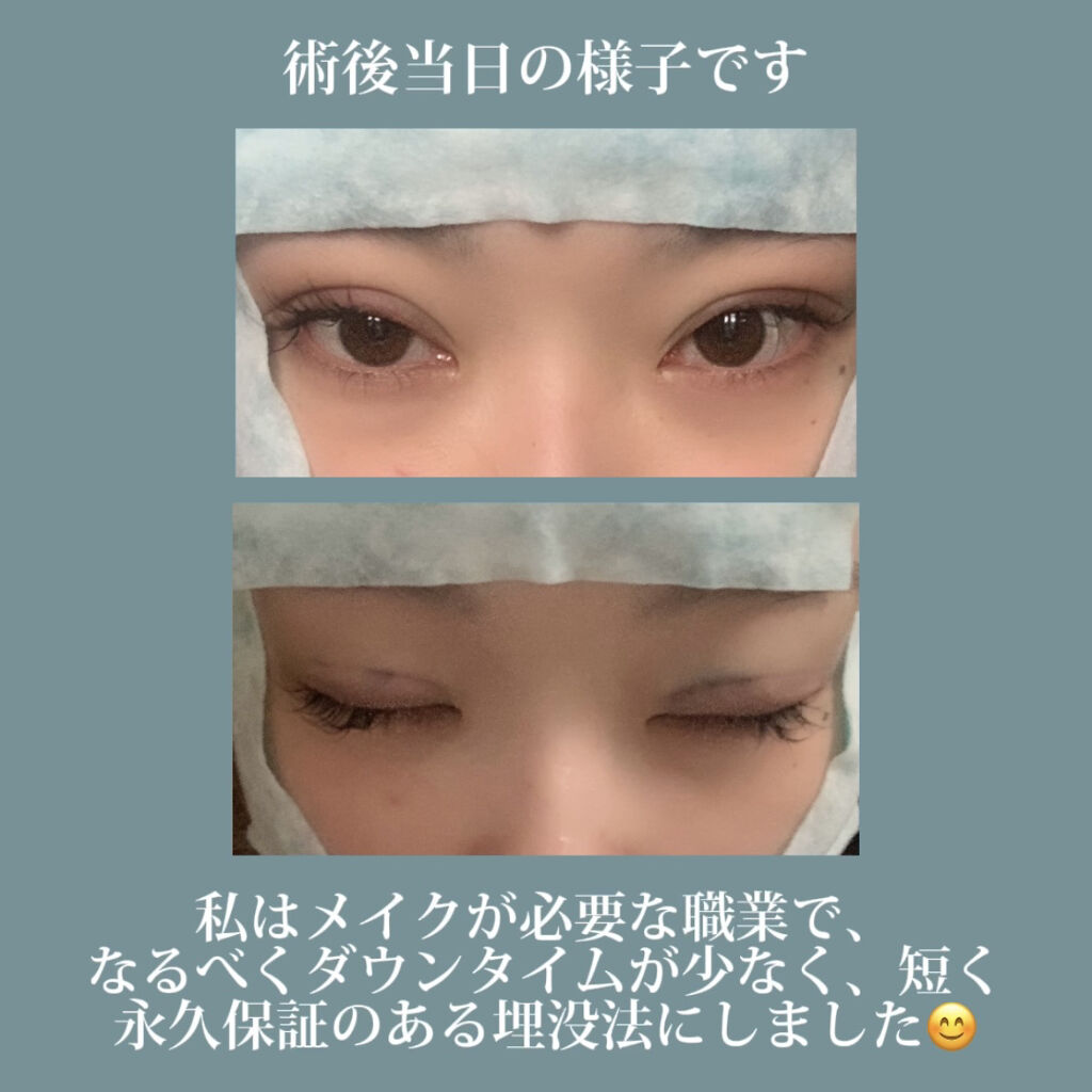 二重整形/その他を使ったクチコミ（2枚目）