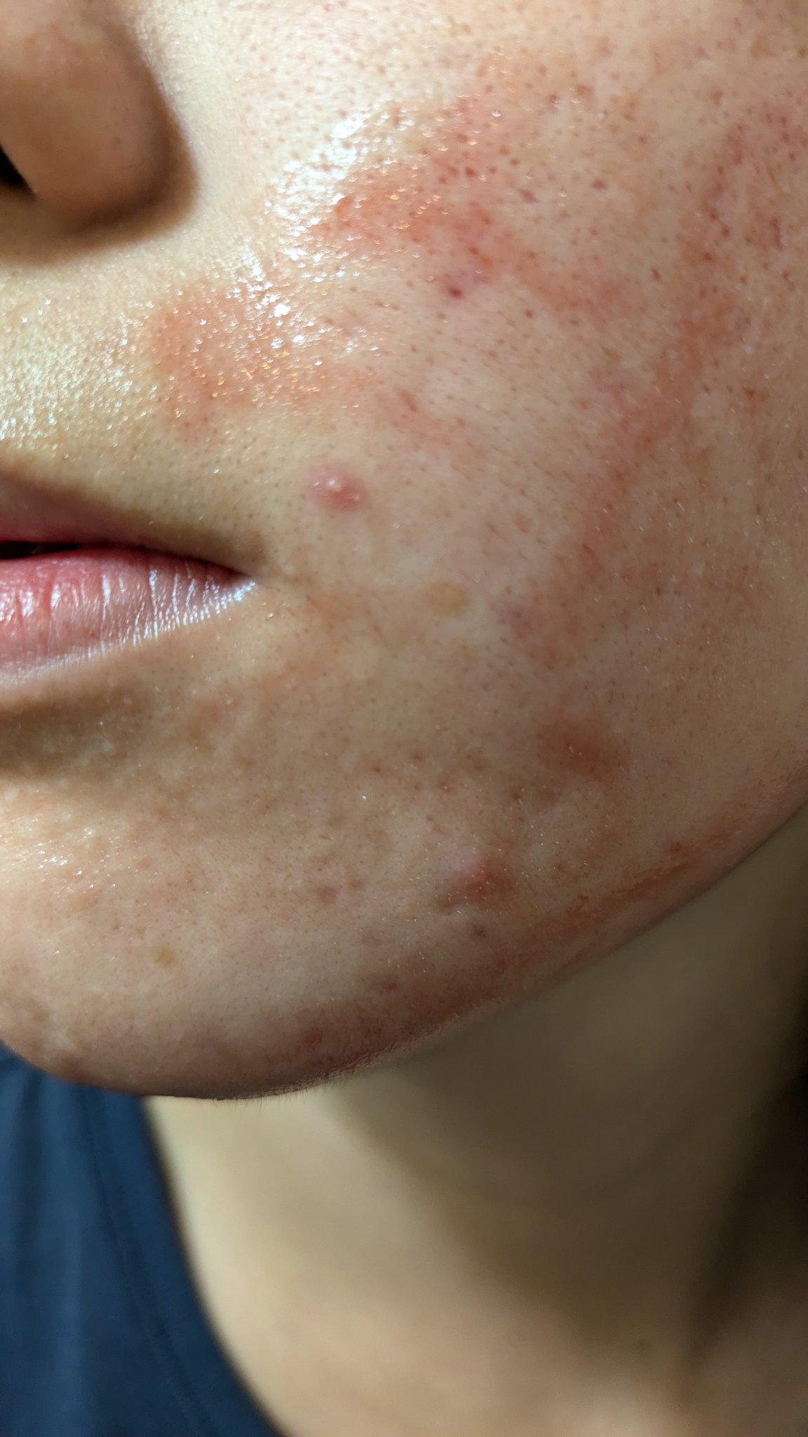 AHA 30% + BHA 2% Peeling Solution/The Ordinary/ピーリングを使ったクチコミ（3枚目）