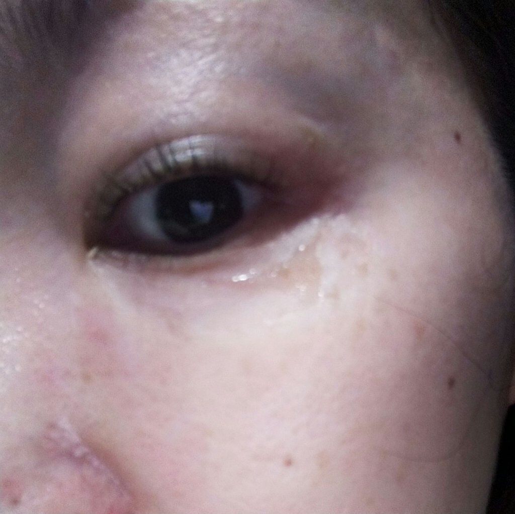 クリアターン ヒアロチューン マイクロパッチ 1500/クリアターン/シートマスク・パックを使ったクチコミ（3枚目）