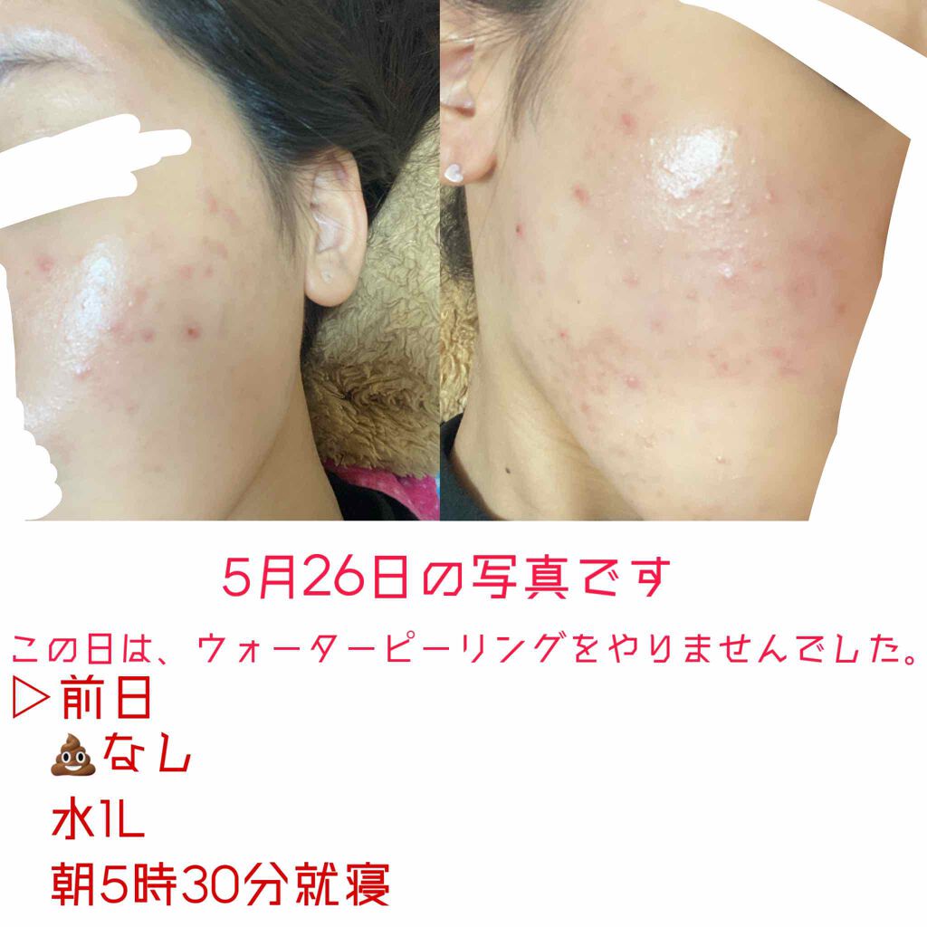 まーち on LIPS 「肌荒れニキビ奮闘日記、三日目二枚目にはこれから、前日何をしたか..」(2枚目)