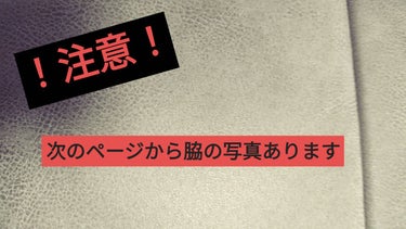 むぎむぎ フォロバ💯 on LIPS 「医療脱毛1回目から1ヶ月ちょい経ちましたので経過レポートです。..」（3枚目）