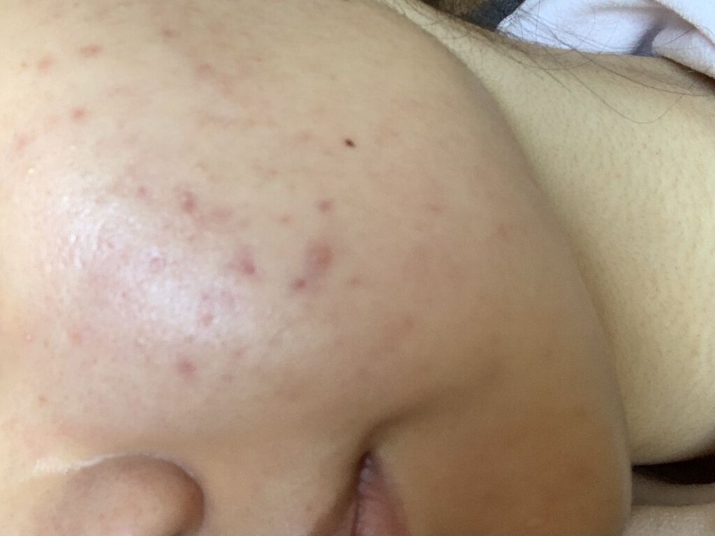 エピデュオゲル/マルホ株式会社/その他を使ったクチコミ（1枚目）