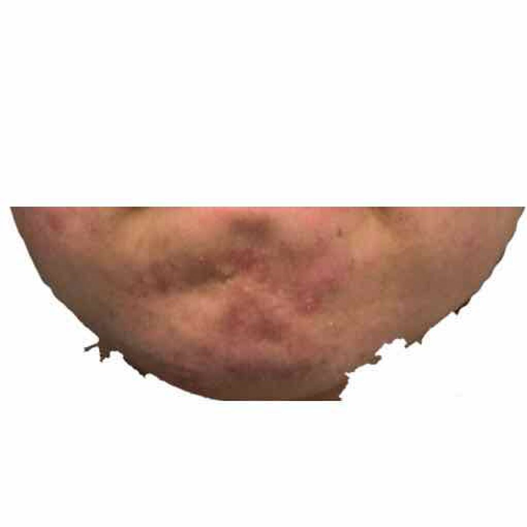 ベジータ on LIPS 「ニキビ日記写真撮るのがめんどくさくなってやめてましたがやってな..」(2枚目)