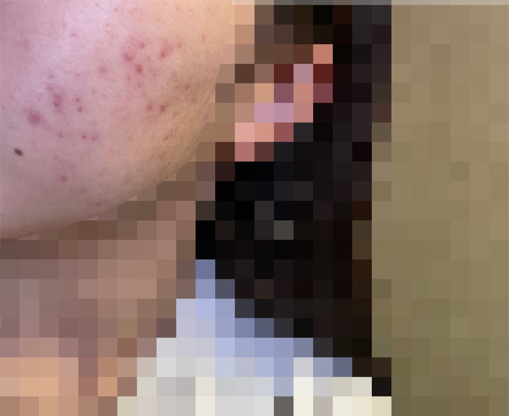 ニキビ治療薬(医薬品)/メンソレータム アクネス/その他を使ったクチコミ（2枚目）