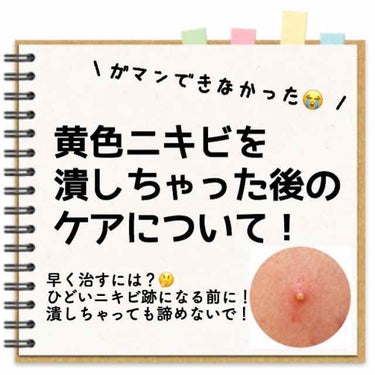 ニキビ潰しちゃったときのケア(後編)です。前回の前編からご覧ください。

後編で気をつけることは、膿を出すときやりすぎないことと、あとは塗り薬を塗ったあと、指で触っちゃったりする人は
絆創膏の両端を2〜