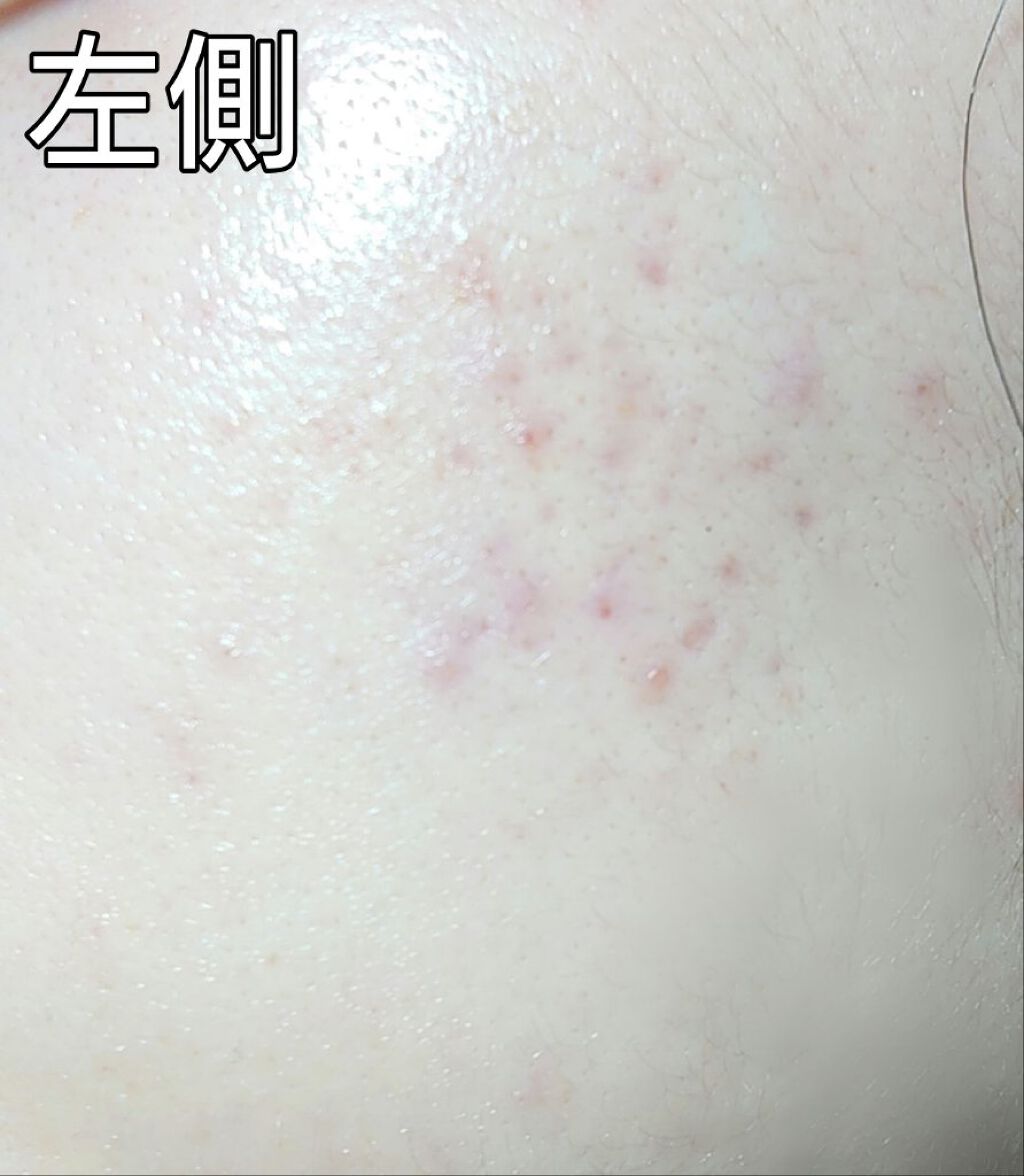 ペアアクネクリームW(医薬品)/ペア/その他を使ったクチコミ（3枚目）