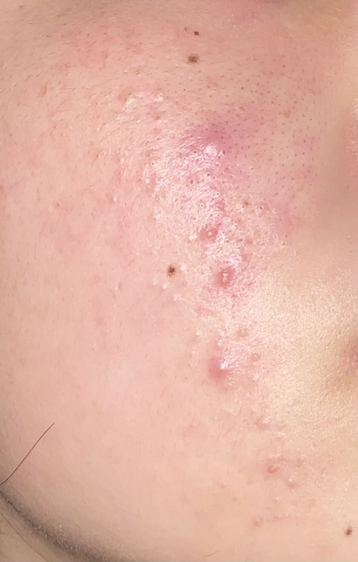 アクアチム軟膏1%/大塚製薬/その他スキンケアを使ったクチコミ（3枚目）