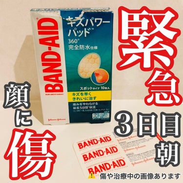 顔の傷へキズパワーパッドを貼り直して
一晩経ちました。

＊＊＊＊＊＊♪＊＊＊＊♪＊＊
■バンドエイド キズパワーパッド
　スポットタイプ

明らかに、貼り直した前よりも
白い部分が小さくなりました！
