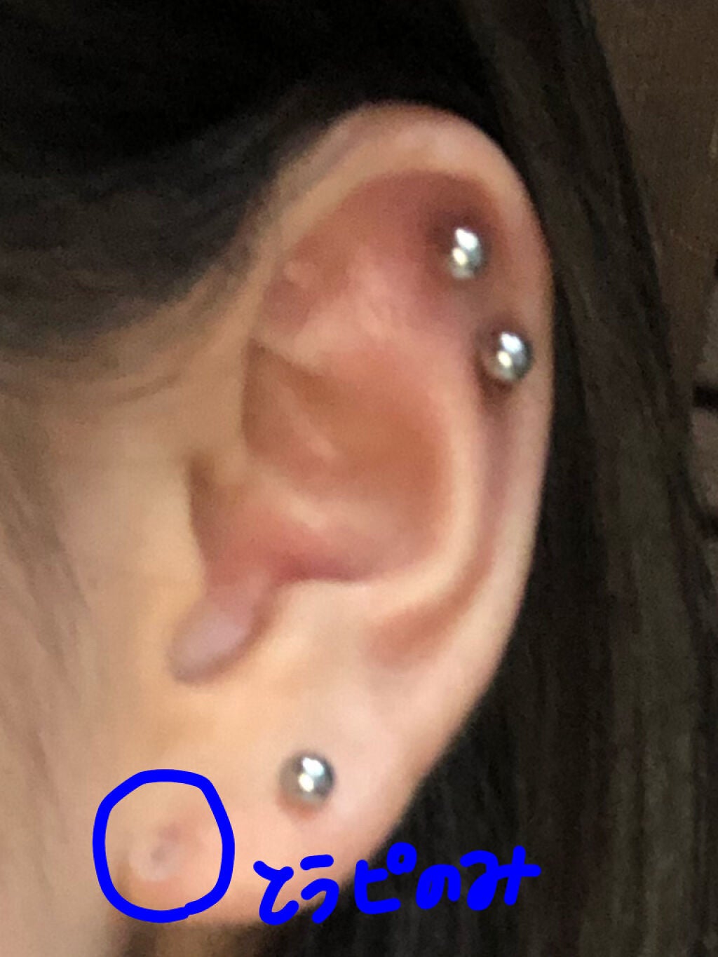 オロナインH軟膏 (医薬品)/オロナイン/その他を使ったクチコミ(3枚目)