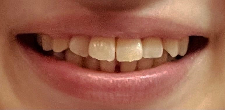 ハナ on LIPS 「矯正4回目(ワイヤー1回目)下の歯にワイヤーがつきました!!!..」(3枚目)