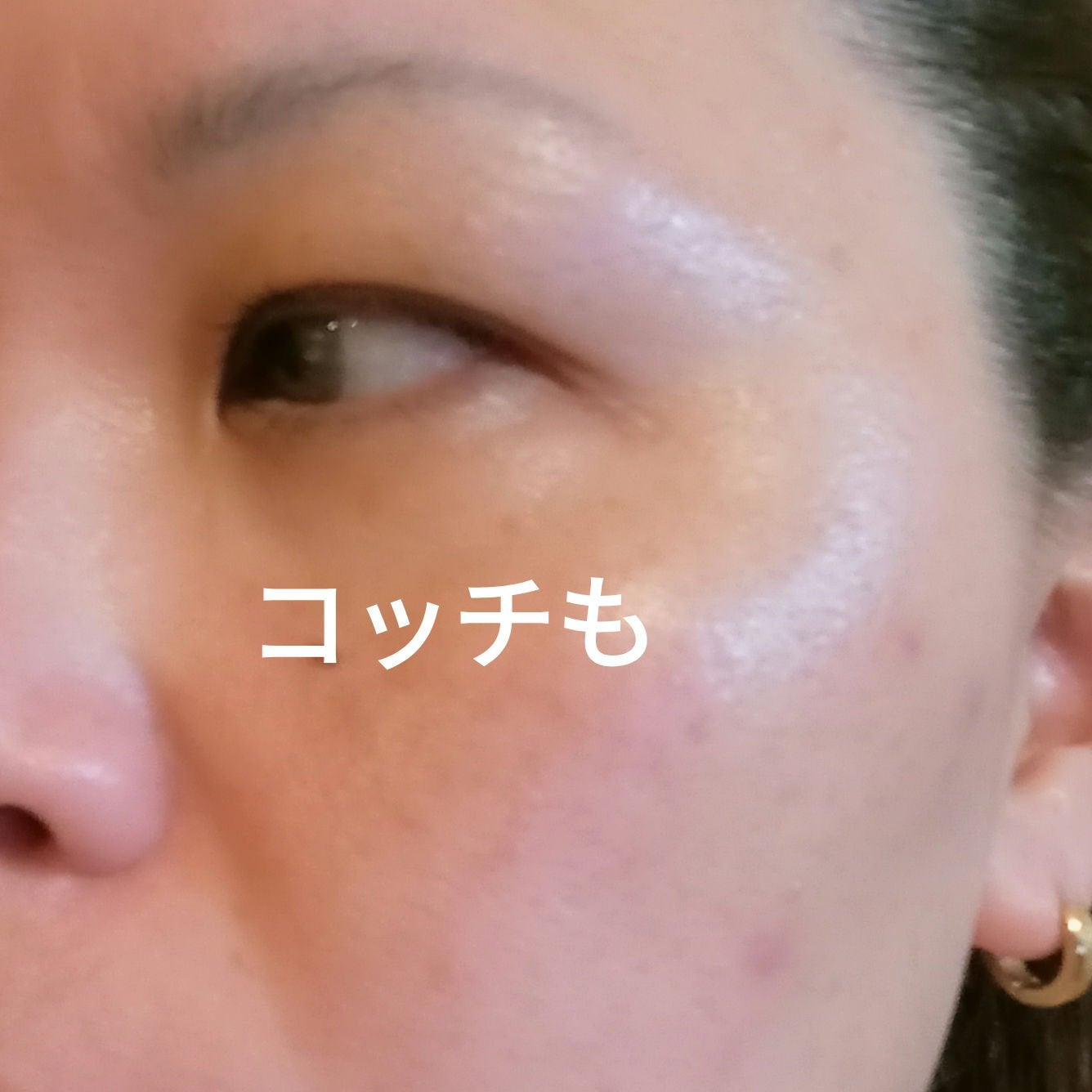 ビヨンセ奥二重向上委員長🥸LIPSパートナー🥳 on LIPS 「明日は施術3回目。前日なので記録用👍まだまだシミはありますがフ..」(2枚目)