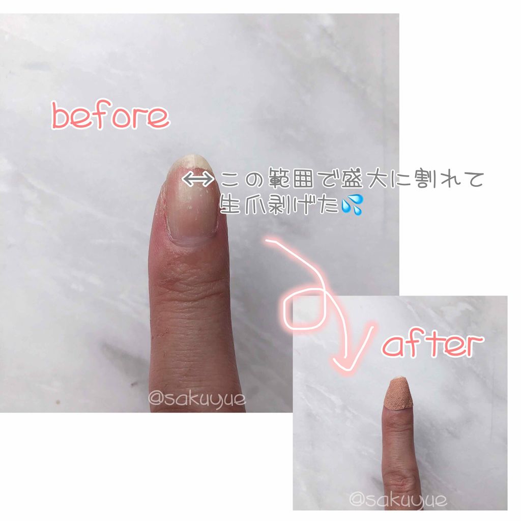 あかぎれ保護バン スポット用/ニチバン/その他を使ったクチコミ（2枚目）