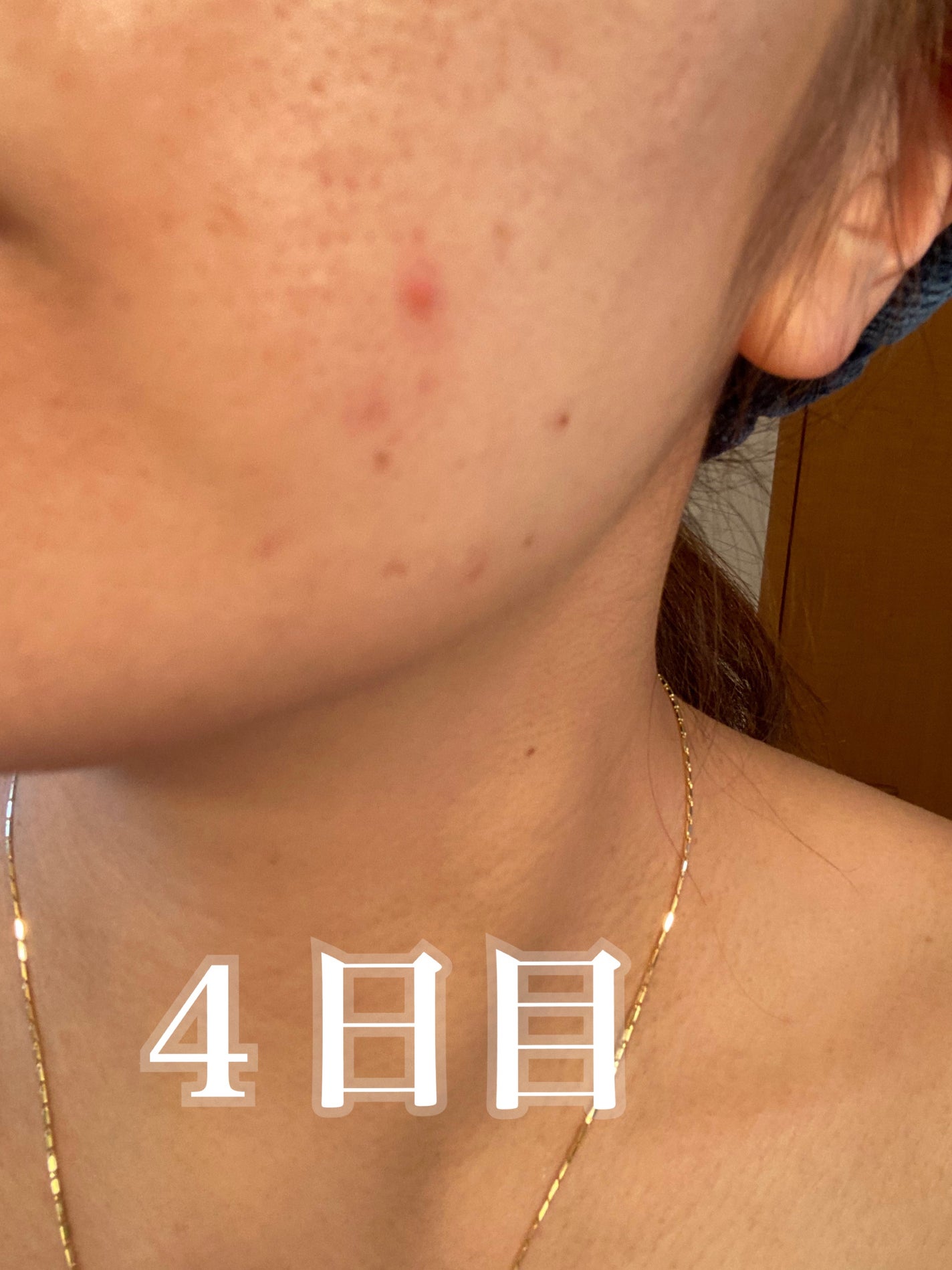 ペアアクネクリームW(医薬品)/ペア/その他を使ったクチコミ(4枚目)