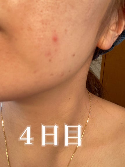 ペアアクネクリームW(医薬品)/ペア/その他を使ったクチコミ(4枚目)