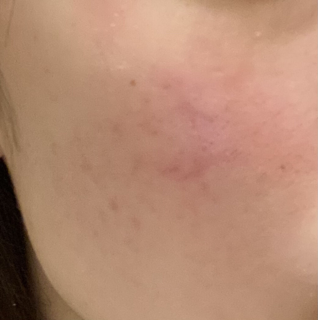 ディフェリンゲル0.1% /マルホ株式会社/その他を使ったクチコミ（1枚目）