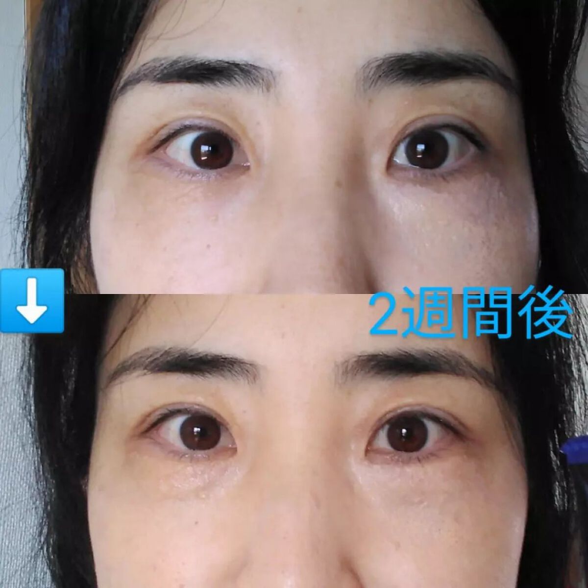 おほあんどうふ on LIPS 「もうすぐアラフィフ突入にして、憧れのプックリ涙袋形成か⁉️たる..」(1枚目)