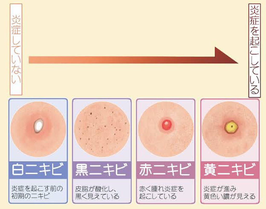 れお on LIPS 「【種類別 ニキビの治し方】こんにちは!しろみです🦔突然ですが皆..」(4枚目)