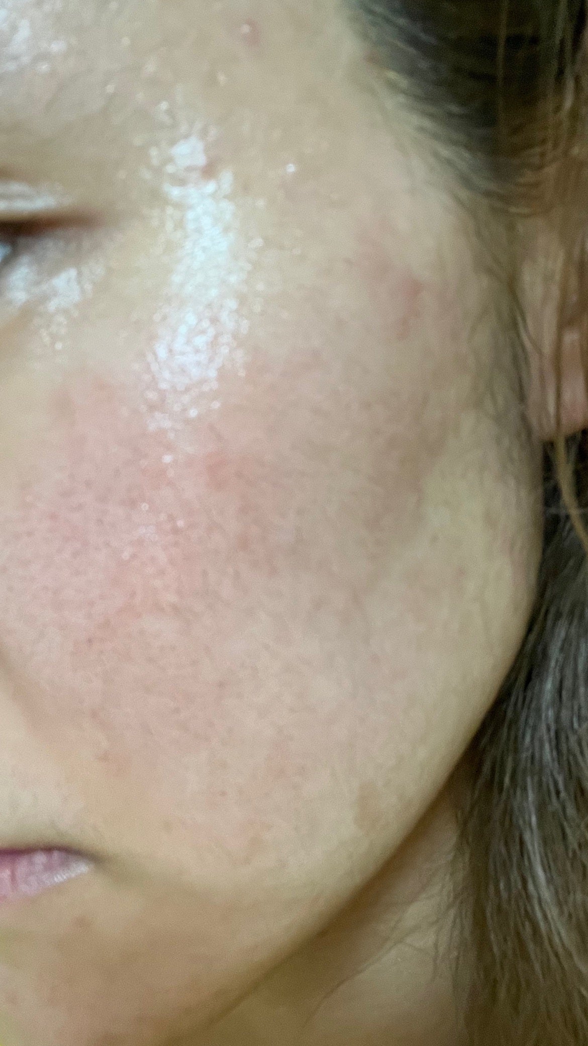 あーちゃん on LIPS 「初投稿失礼します🙇♀️あーちゃんです!!私の肌歴史を紹介しま..」(5枚目)