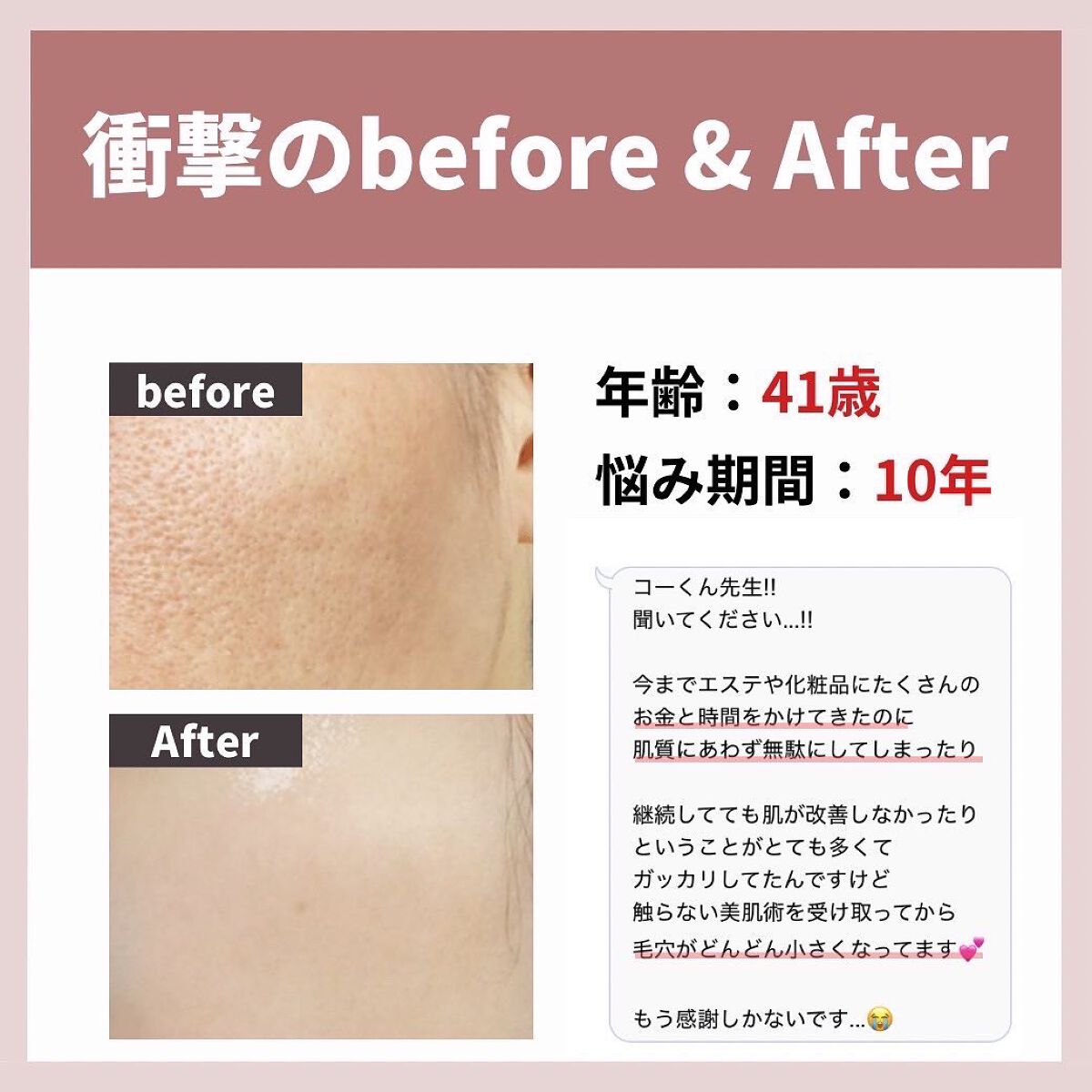 あなたの肌に合ったスキンケア💐コーくん先生 on LIPS 「【4月までに毛穴の開きをなくしたい人だけ見てください。】.
...」(3枚目)