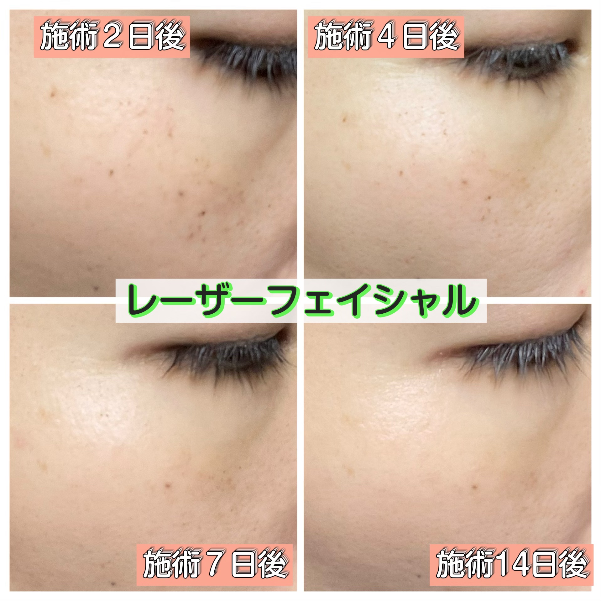 バイオ コンディショニング エッセンス/IOPE/ブースター・導入液を使ったクチコミ（2枚目）