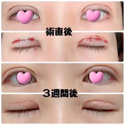 にゃみー★フォロバ投稿ある方 on LIPS 「【二重全切開+たるみ取りレポ②】施術から3週間経ちました。前回..」(3枚目)