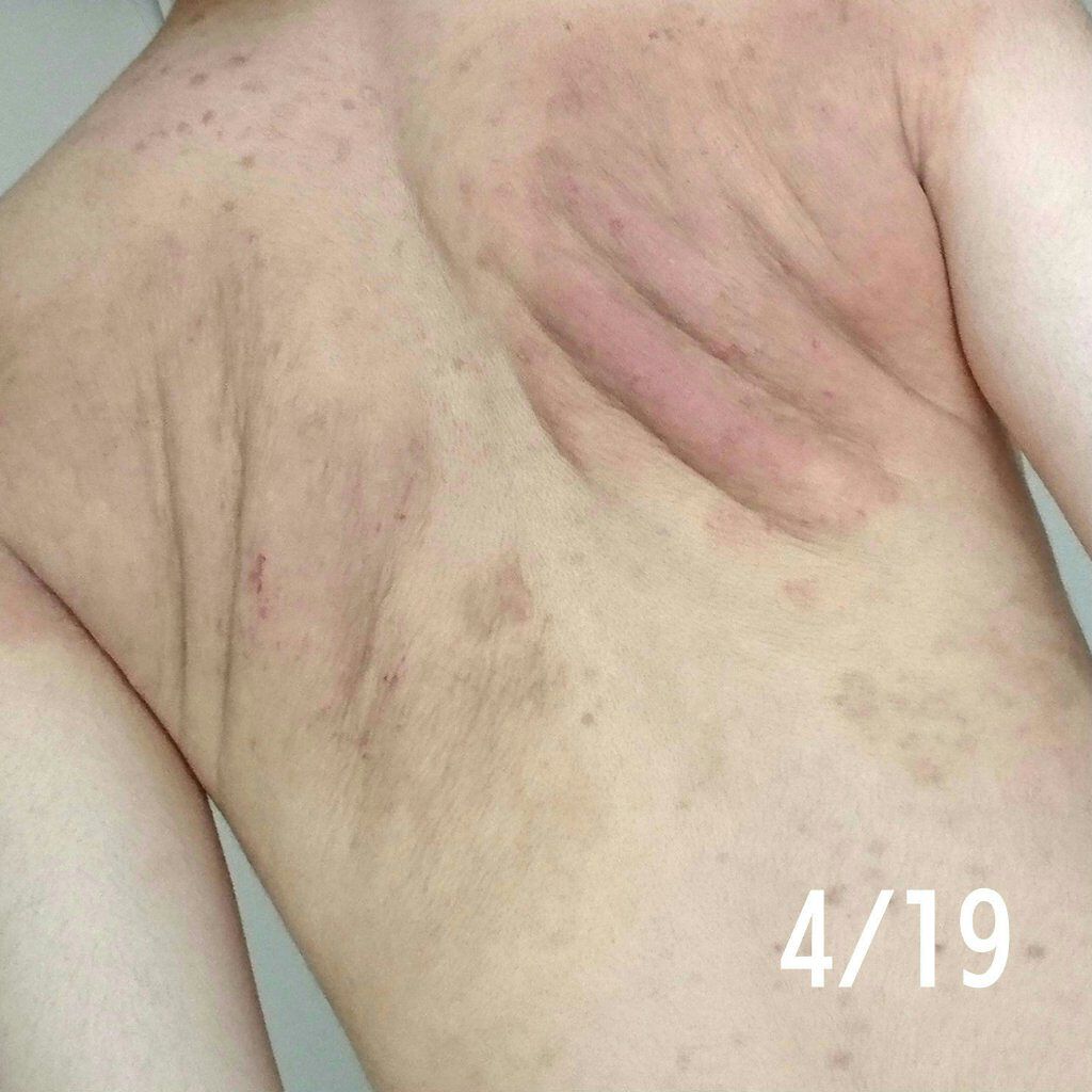 メンタームＥＸプラスクリーム(医薬品)/メンターム/その他を使ったクチコミ（3枚目）