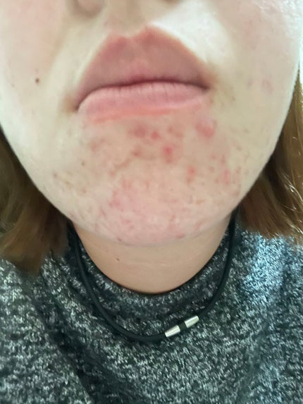 coral_lips_pr2 on LIPS 「助けてください。ニキビがずっと治りません色々試してはいるのです..」(2枚目)