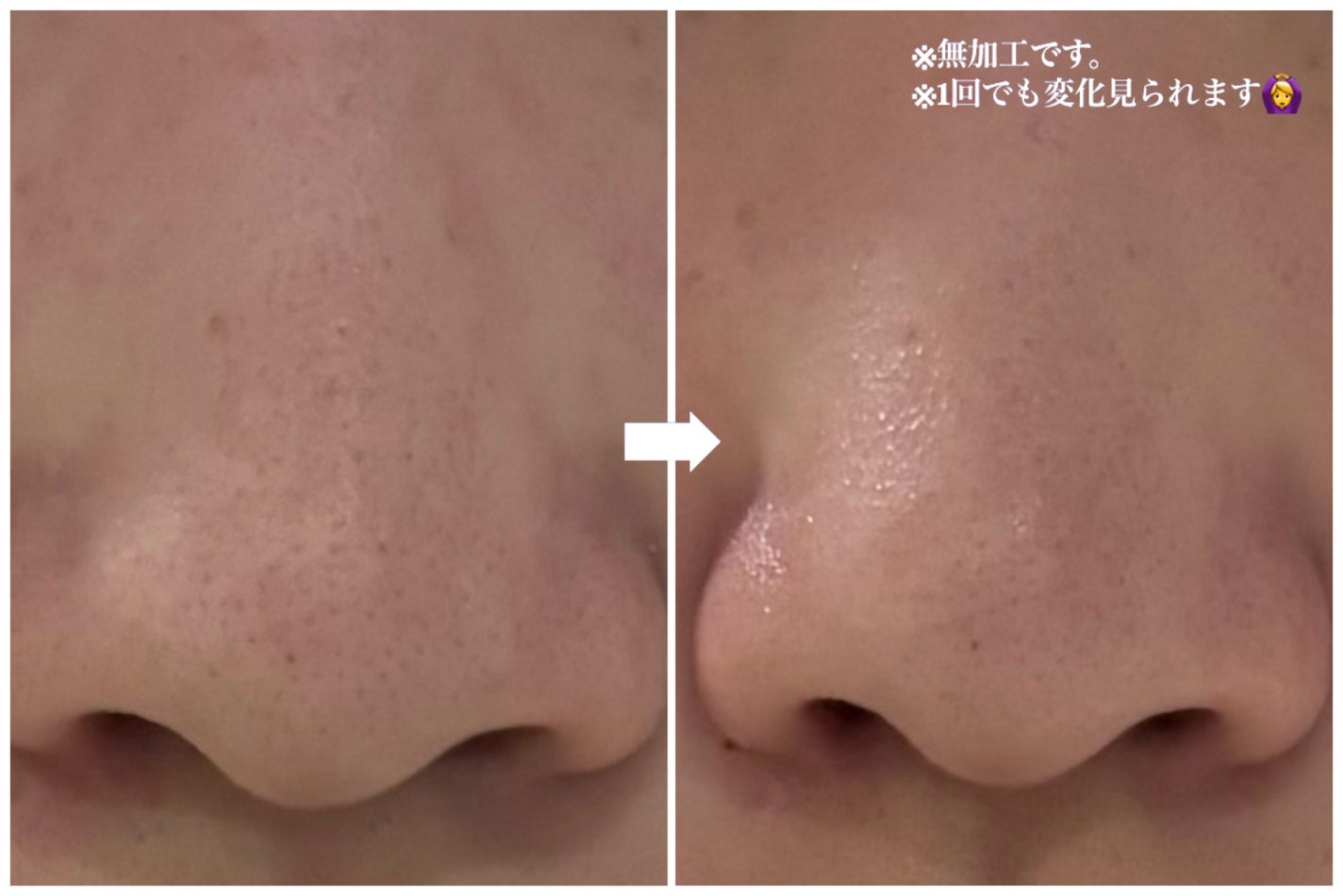 ノーズピーリングパック/One-day's you/シートマスク・パックを使ったクチコミ(3枚目)