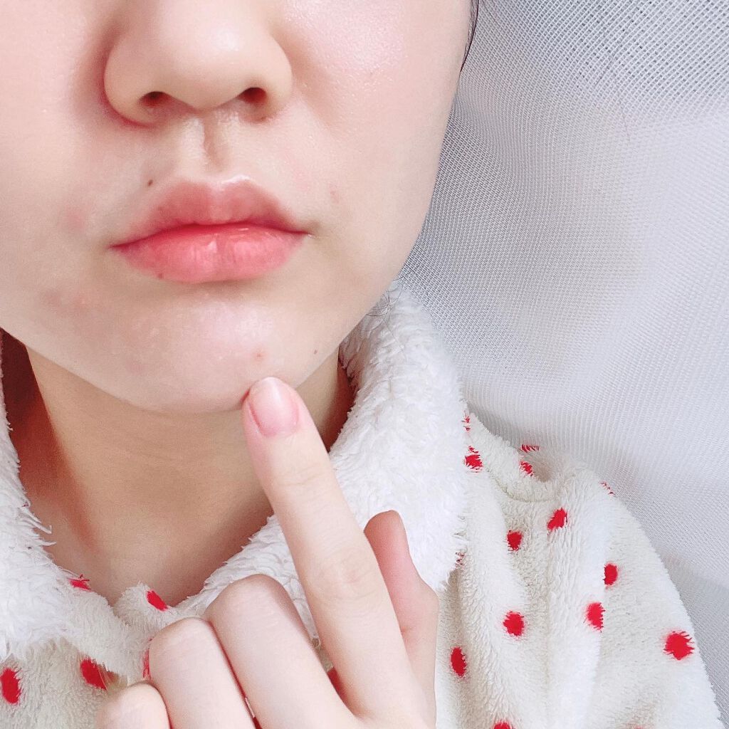 プロCICA クリアスポットパッチ/VT/その他スキンケアを使ったクチコミ(5枚目)