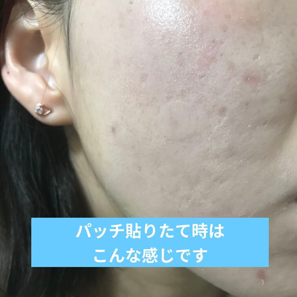 プロCICA クリアスポットパッチ/VT/その他スキンケアを使ったクチコミ(8枚目)