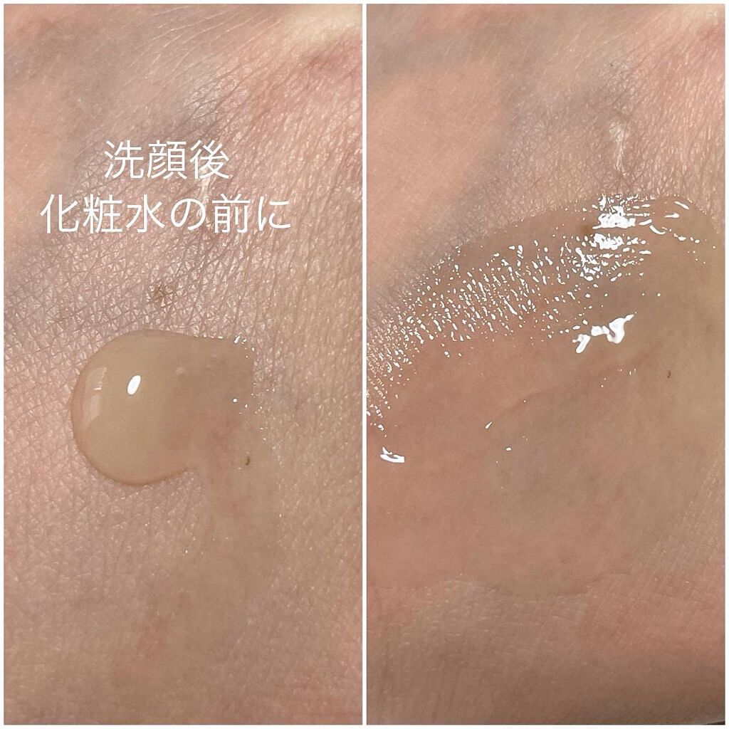 natsumi on LIPS 「.ニキビが治ったあとに使う【アットノンニキビあとケアジェル】...」(2枚目)