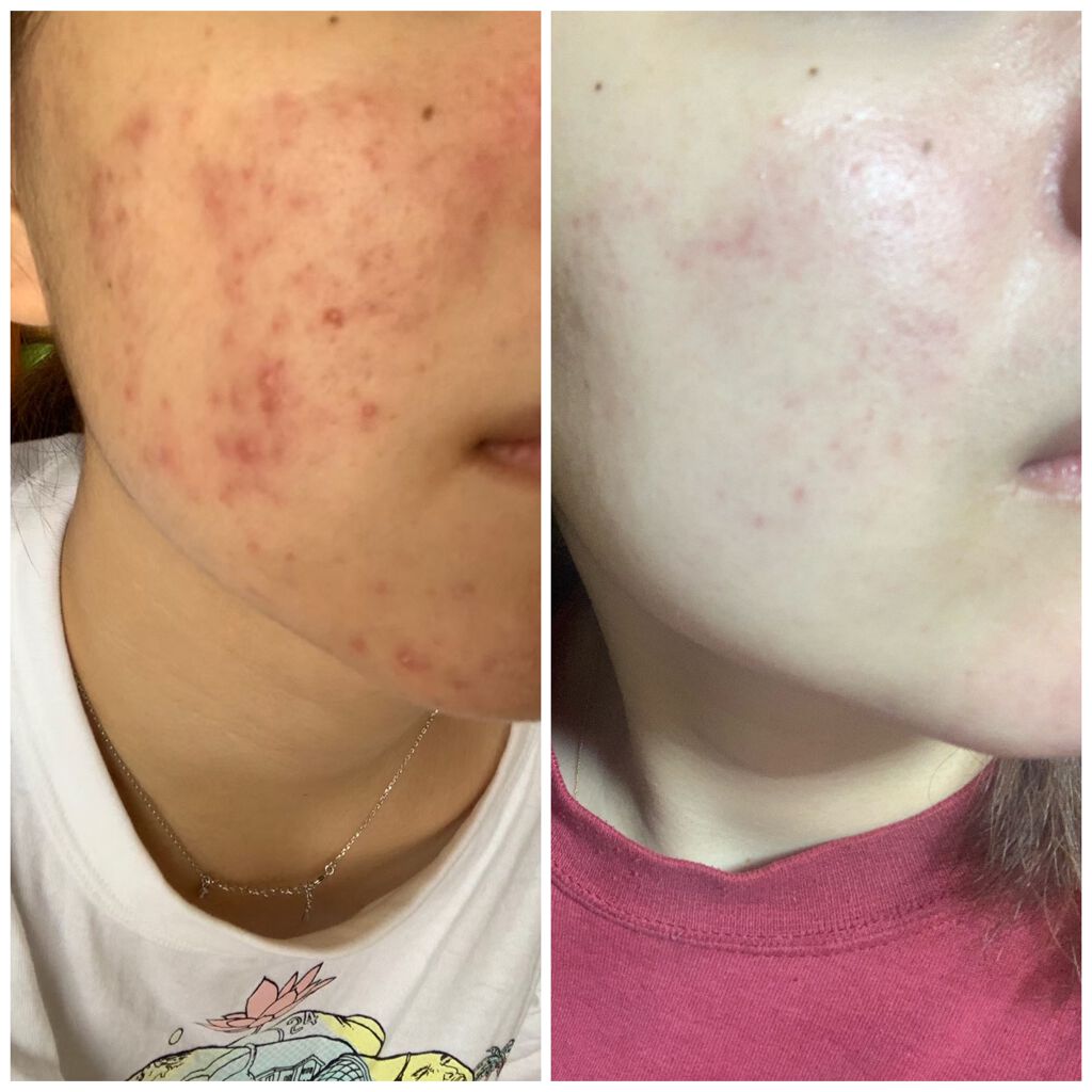 サンシビオ エイチツーオー D/ビオデルマ/クレンジングウォーターを使ったクチコミ(2枚目)