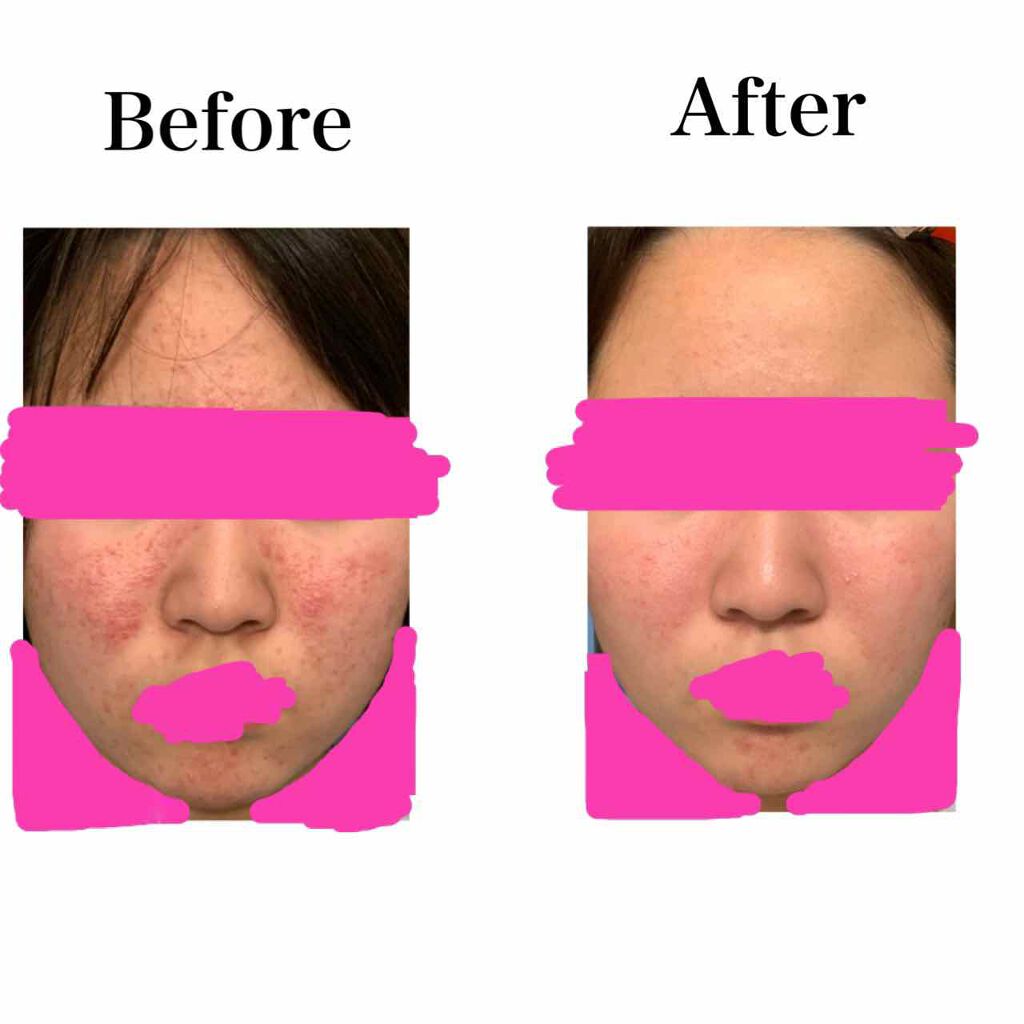 モイスト ローション/リッツ/化粧水を使ったクチコミ(1枚目)