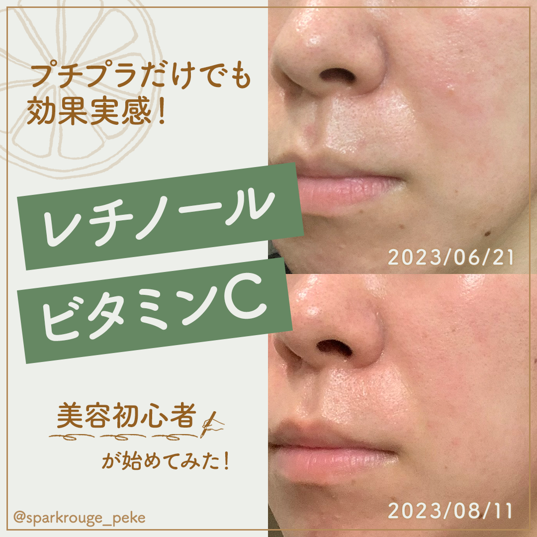 毛穴フォーカスVC VC3エッセンス/pdc/美容液を使ったクチコミ（1枚目）