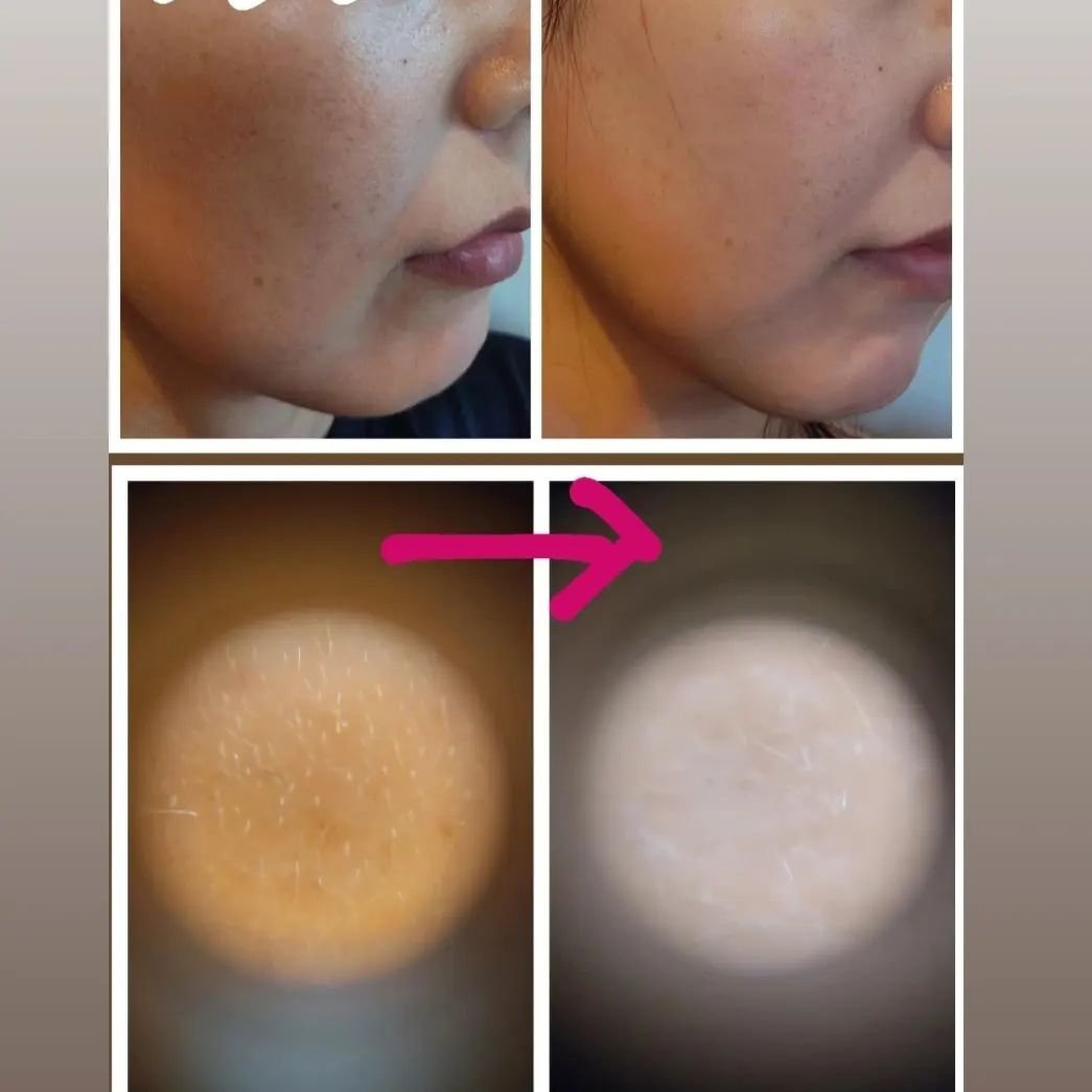 リードルショット リフティングセラム/VT/美容液を使ったクチコミ（2枚目）