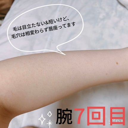 光脱毛器 VIO/Sarlisi/家庭用脱毛器を使ったクチコミ(2枚目)