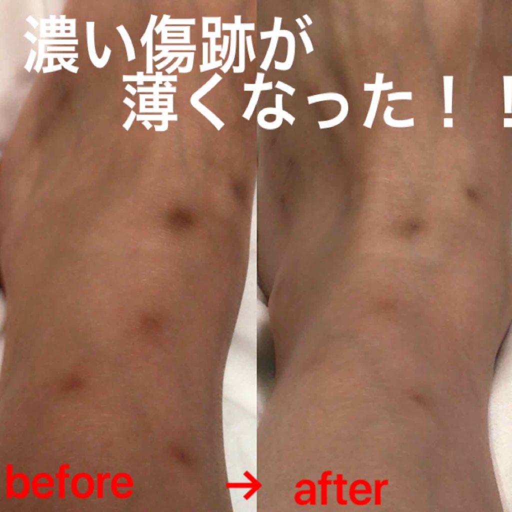 アットノンEX ジェル(医薬品)/アットノン/その他を使ったクチコミ（1枚目）