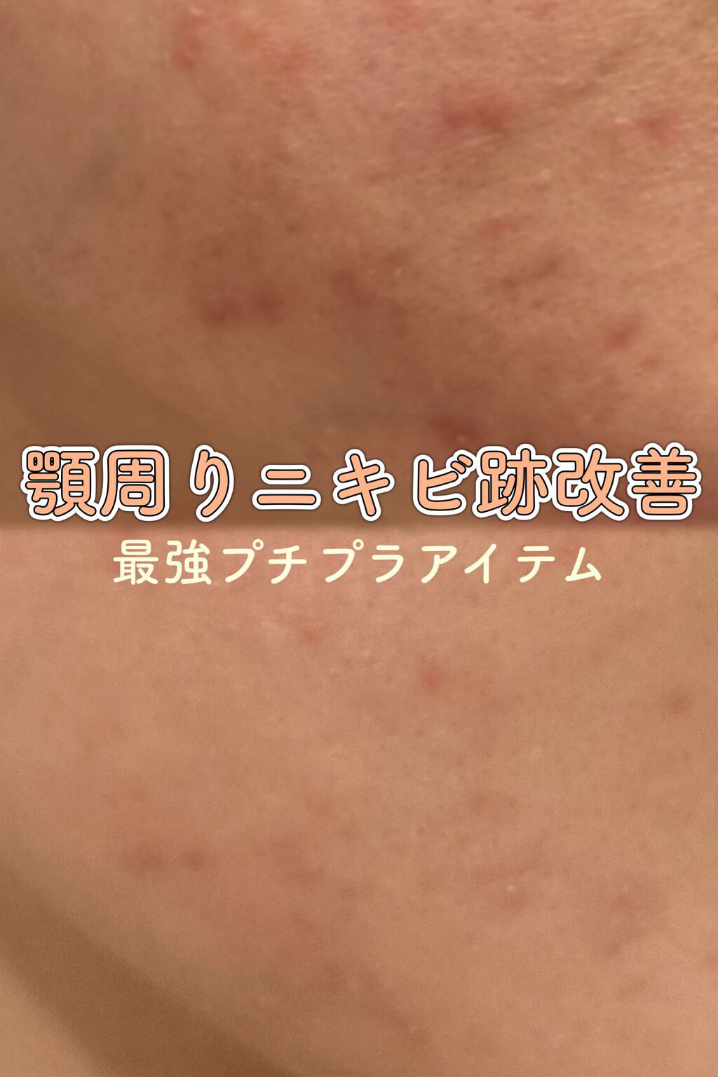 薬用しみ集中対策 プレミアム美容液/メラノCC/美容液を使ったクチコミ（1枚目）