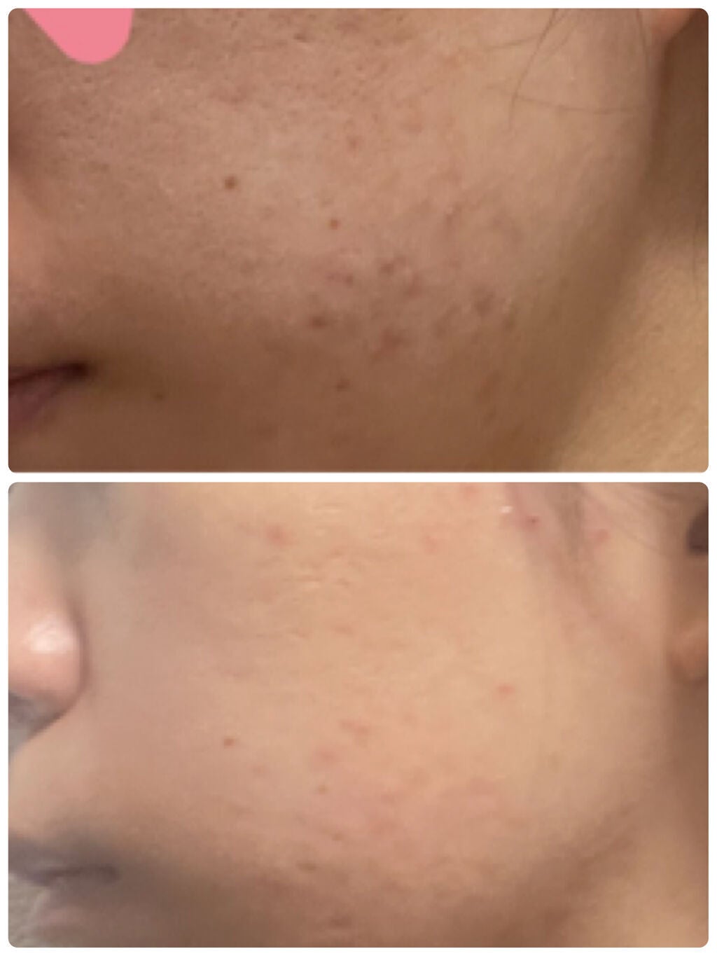 にちか on LIPS 「《使い切りレビュー》 ⚠️2枚目以降閲覧注意ニキビ治療薬 AP..」(3枚目)