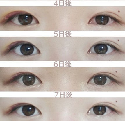 LOUJENE LJ メッシュシートでこっそりふたえのクチコミ「前回の投稿にはたくさんのいいねありがとうございました!
※2ページから整形前の目の写真で.....」(3枚目)