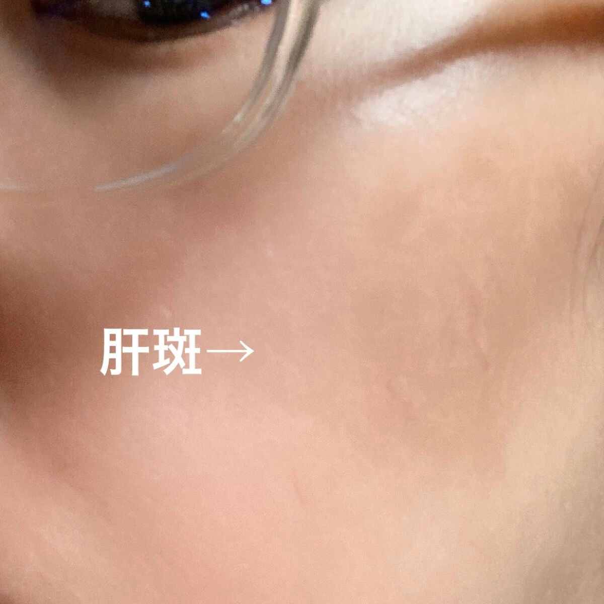 ためしたがり43歳 on LIPS 「肝斑ボヤァ〜が嫌すぎる!見ていただきたい。シャドウかよ、ってぐ..」(1枚目)