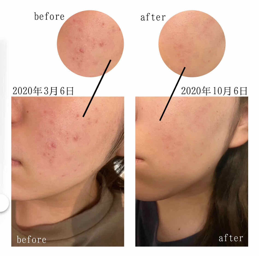 ペアアクネクリームW(医薬品)/ペア/その他を使ったクチコミ（3枚目）