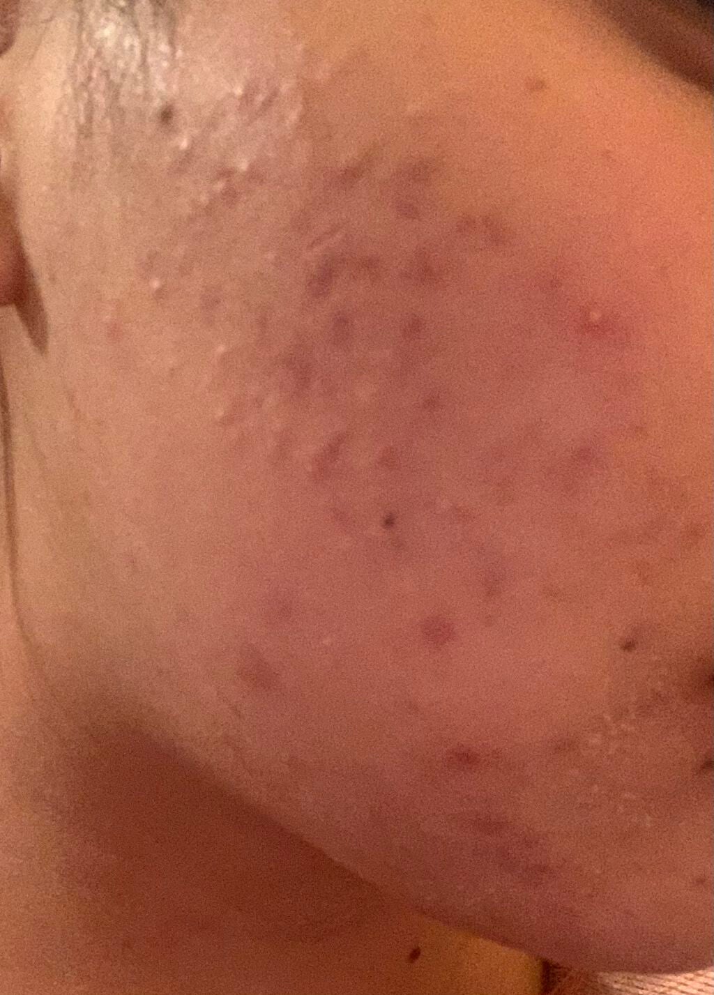 とろり on LIPS 「はい!ニキビ!!!!(写真撮影風)いや酷くなってますやん.....」(2枚目)